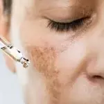 ⁠Tratamiento para melasma