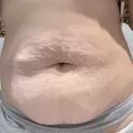 Lipo Barrido