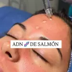 Tratamiento con ADN de salmón PDRN