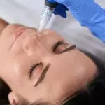 Microneedling-Dermapen