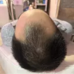 Mesoterapia Capilar
