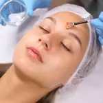 Peeling Químico Facial