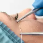 Hilos re absorbibles de Colágeno