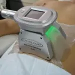 CRIOLIPOLISIS