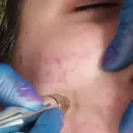 Tratamiento cicatrices de acné