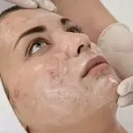 Tratamiento anti-acné